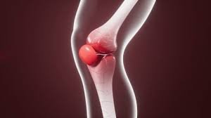 Osteoarthritis knee treatment in Chhindwara