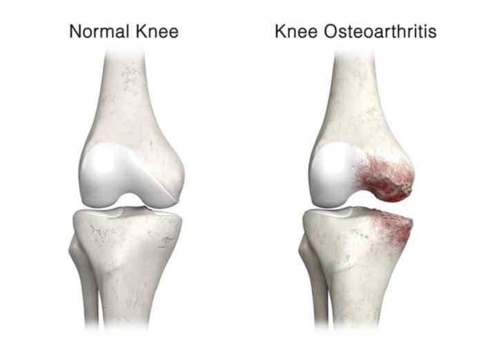 osteoarthritis knee treatment in jabalpur