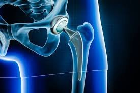 Revision hip replacement in Harda