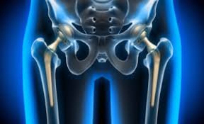 Revision hip replacement in Chhindwara