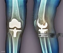 Revision knee replacement in Harda