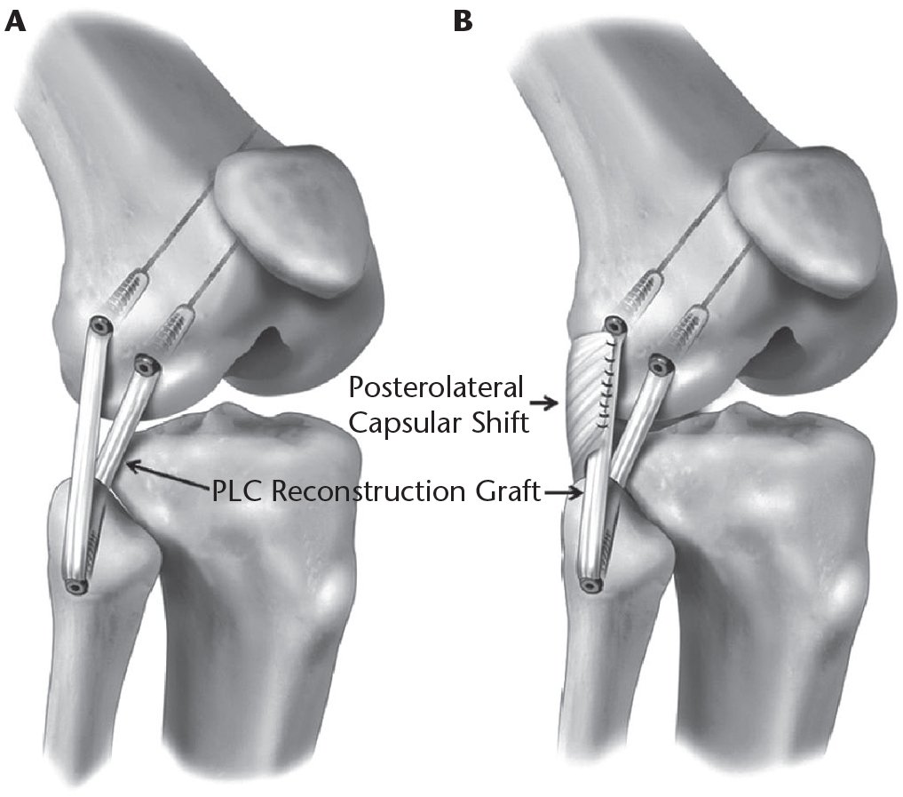 Revision knee replacement in Jabalpur