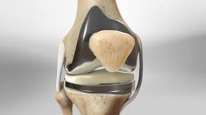Revision knee replacement in Seoni