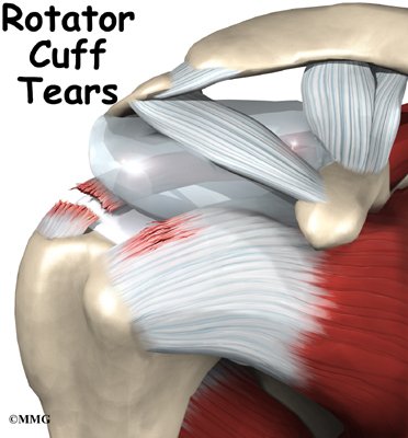 rotator cuff tear treatment in adilabad