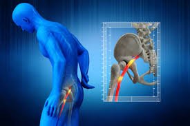 Sciatica surgery specialist in Harda