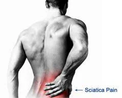 Sciatica surgery specialist in Chhindwara