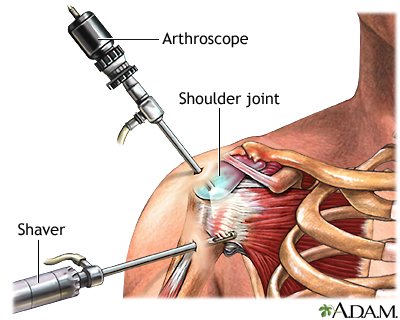 Shoulder arthroscopy in Jabalpur