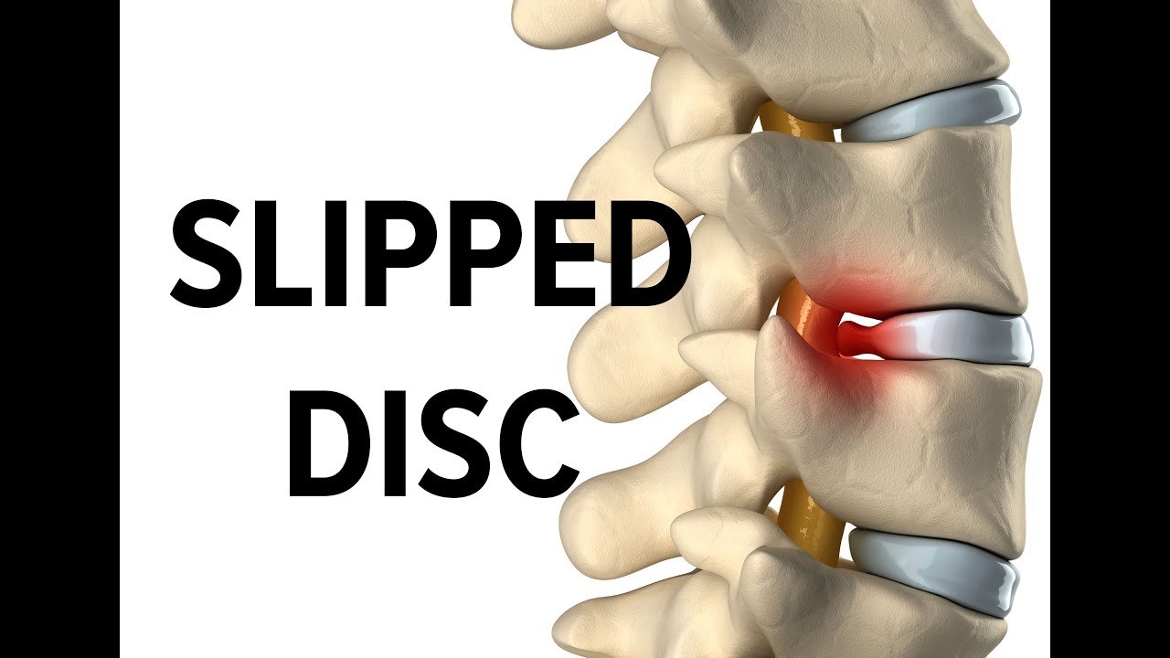 Slipped disc surgery specialist in jabalpur