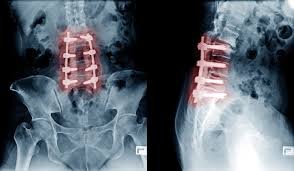 Spinal cord decompression in Hoshangabad
