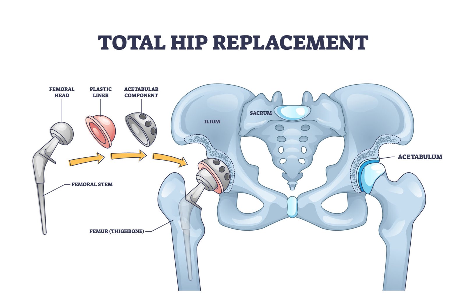 total hip replacement