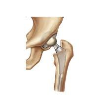 Total hip replacement (THR) in Seoni