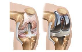 Total knee replacement (TKR) in Chhindwara