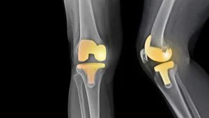 Total knee replacement (TKR) in harda