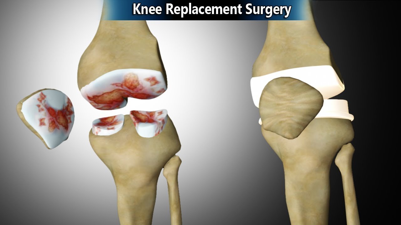 Total knee replacement (TKR)in Adilabad.