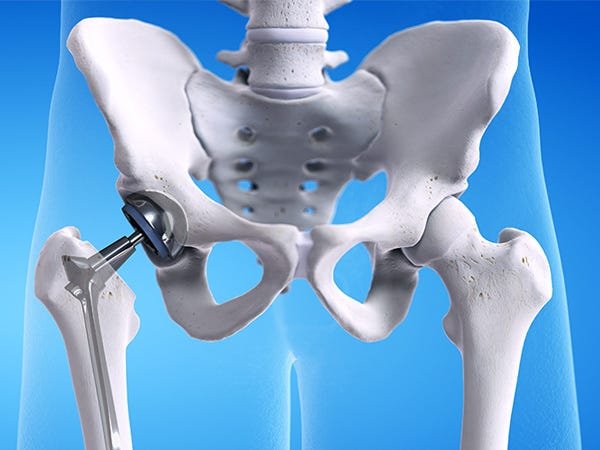 best hip replacement doctor in adilabad