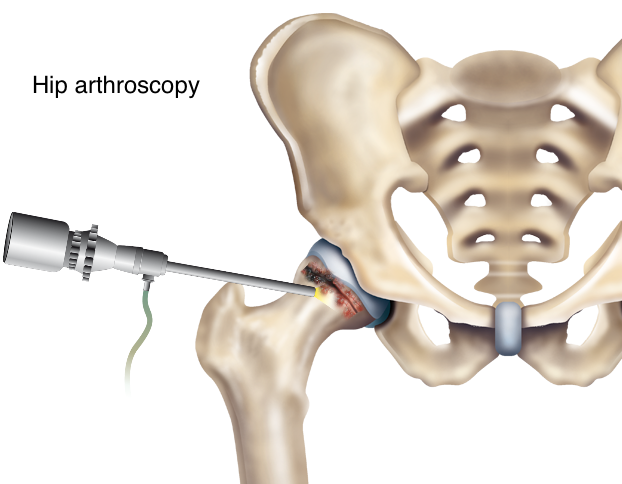 hip arthritis surgery