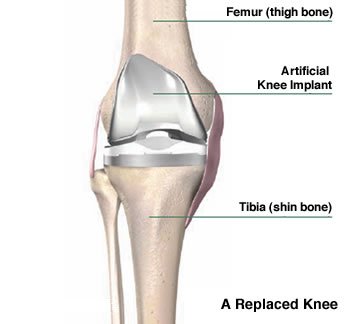 knee replacement surgeon in jabalpur