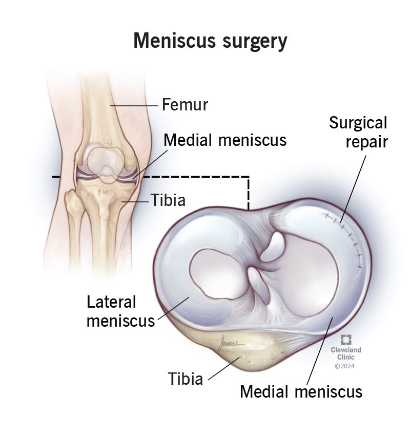 meniscus repair surgery specialist in adilabad