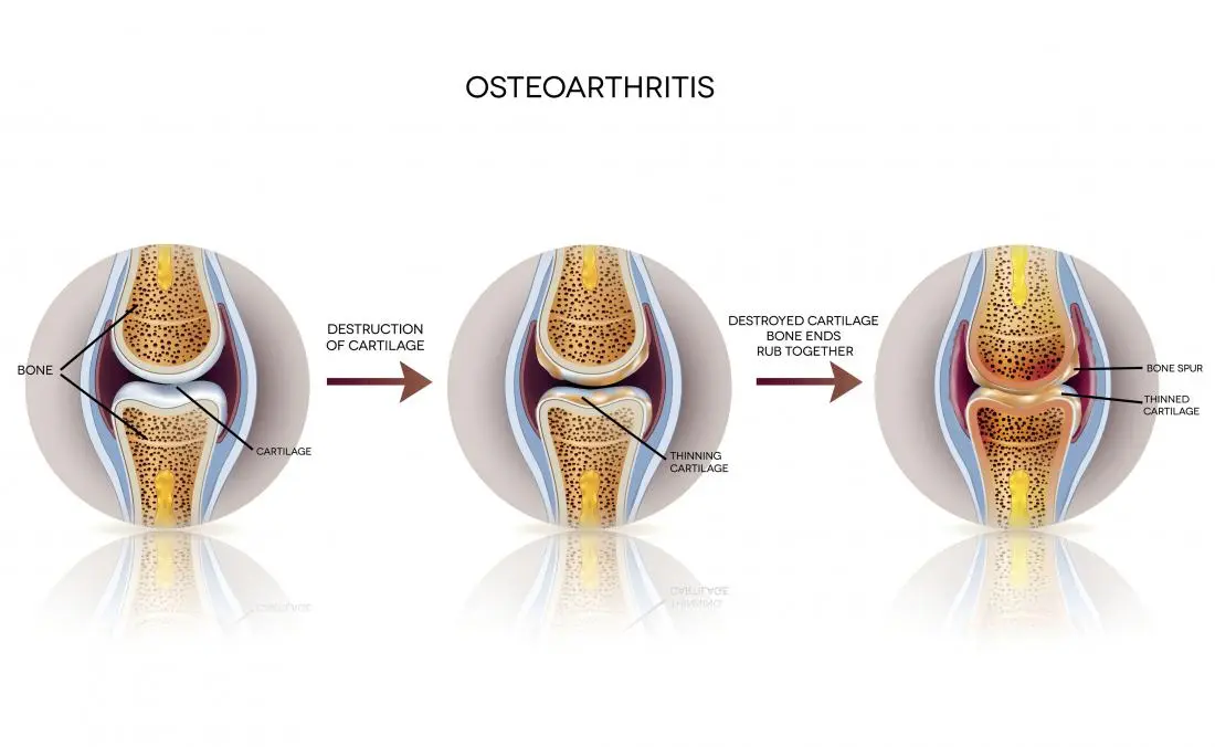 osteoarthritis-knee treatment in adilabad