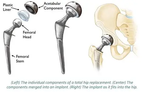 primary hip replacement in adilabad