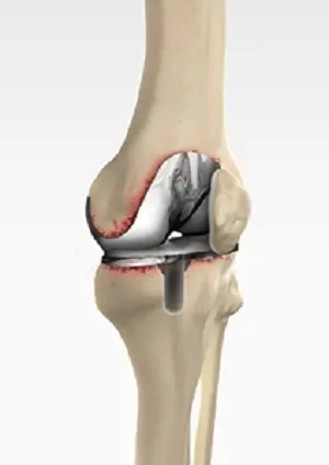 revision-knee-replacement in adilabad