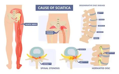 sciatica surgery specialist in adilabad