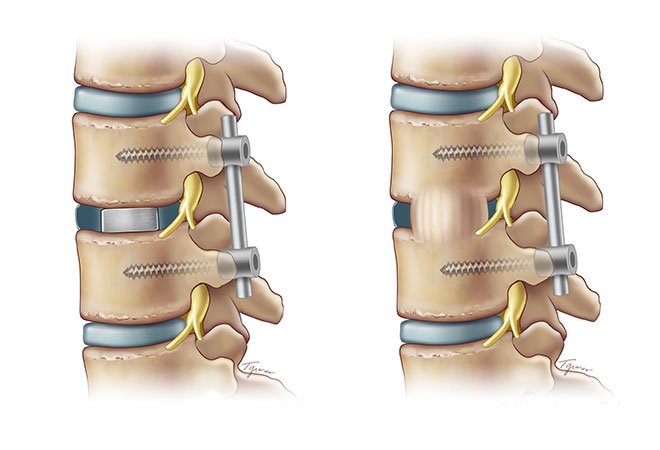 spine fusion surgery in jabalpur
