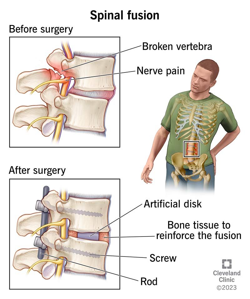 spine fusion surgery specialist in adilabad