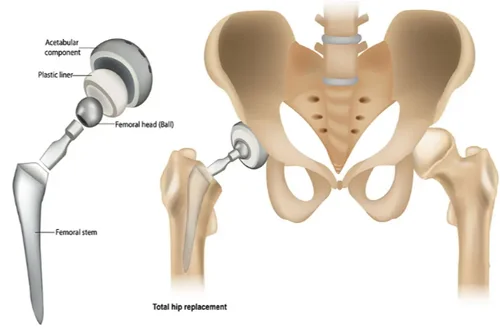 total hip replacement in adilabad